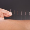 Acupuncture 101: Glossary and Tutorial