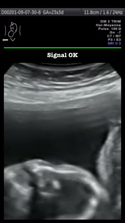Baby UltraSound