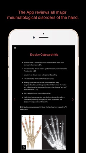 ESIMR: Uncovering The Hand Radiograph