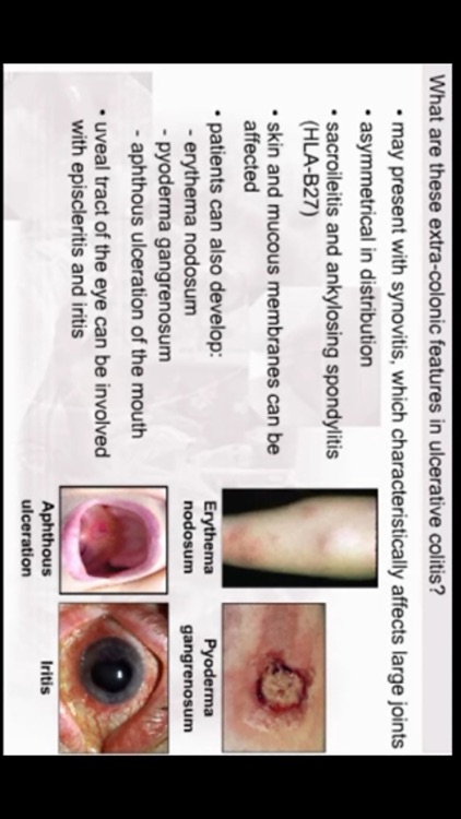 AnswersIn Ulcerative Colitis