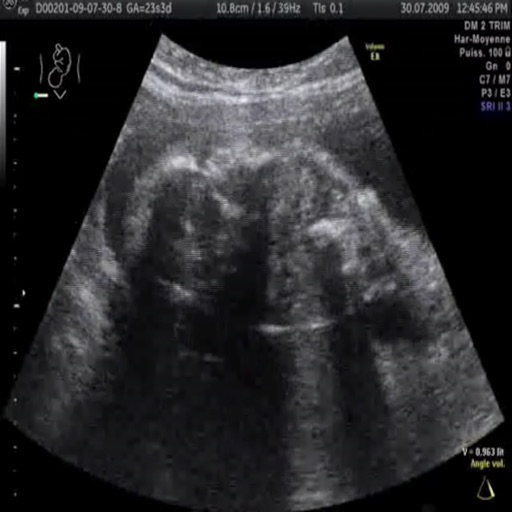 Baby UltraSound