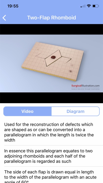 Surgical Flaps