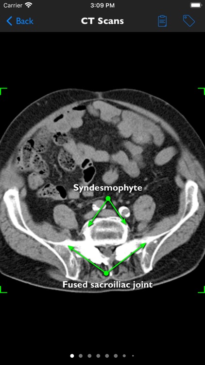 iAnkylosingSpondylitis Pro screenshot-6