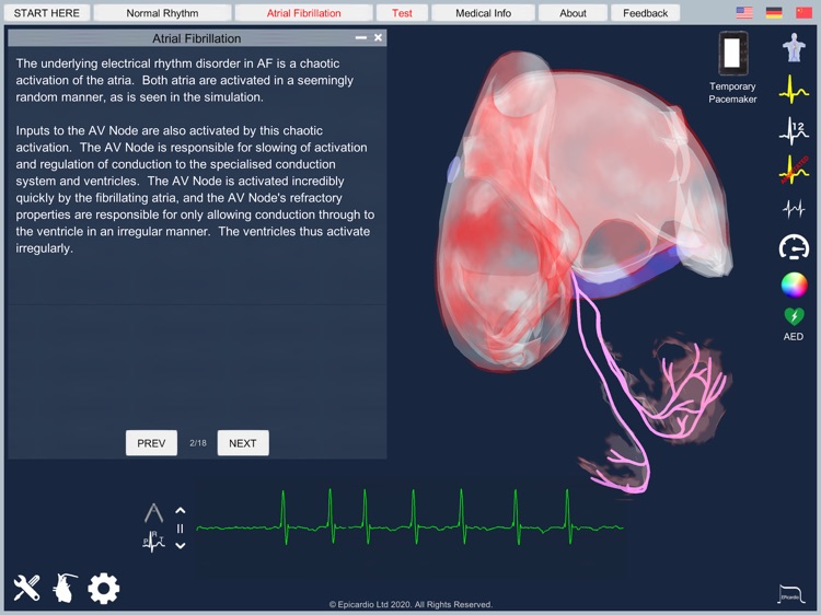Atrial Fibrillation