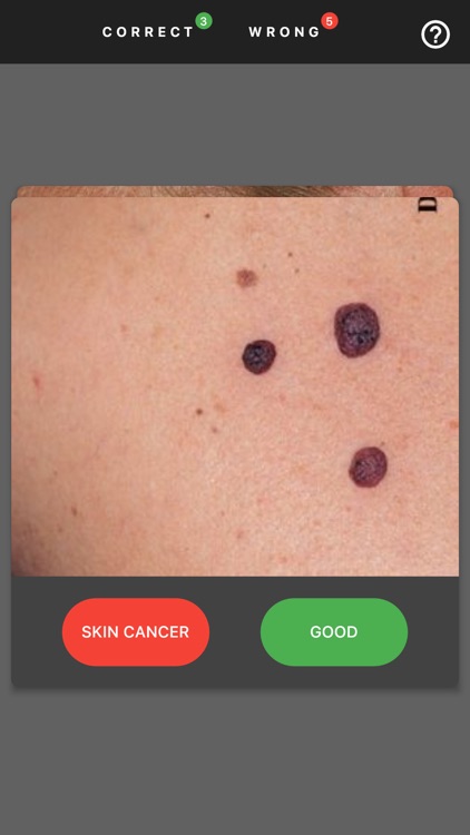 MelanomaExam