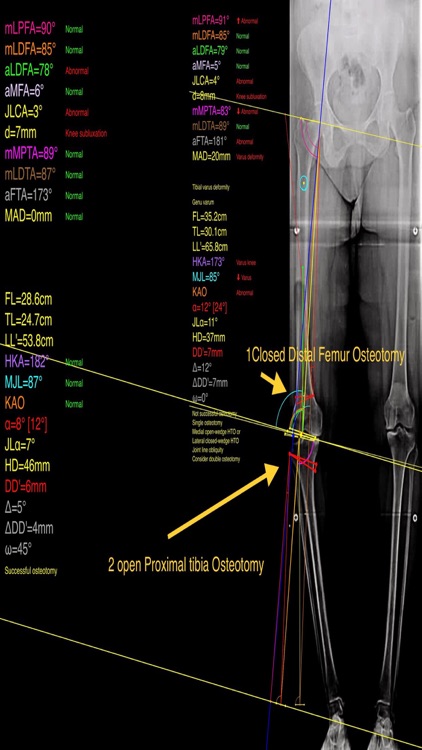 OsteotomyApp screenshot-4