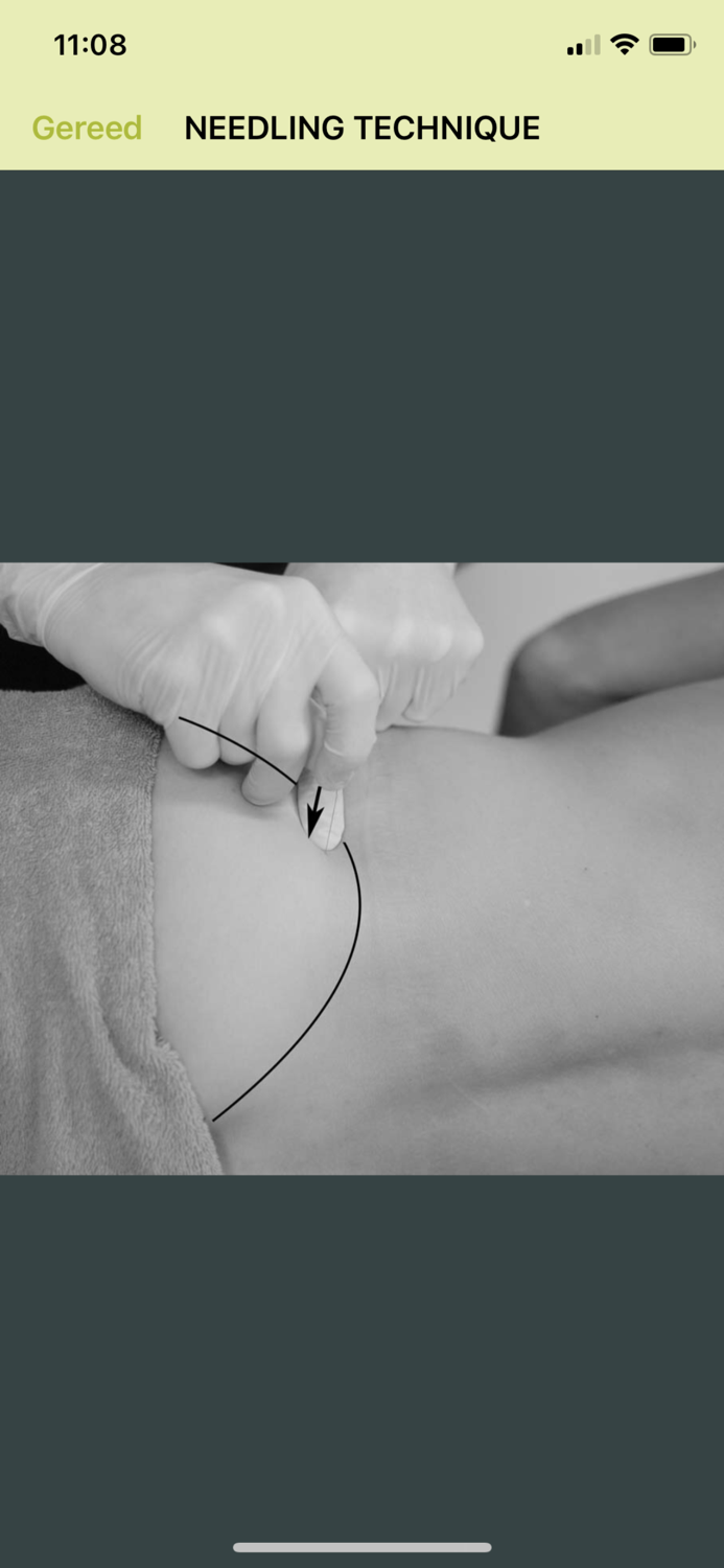 Dry Needling Guide