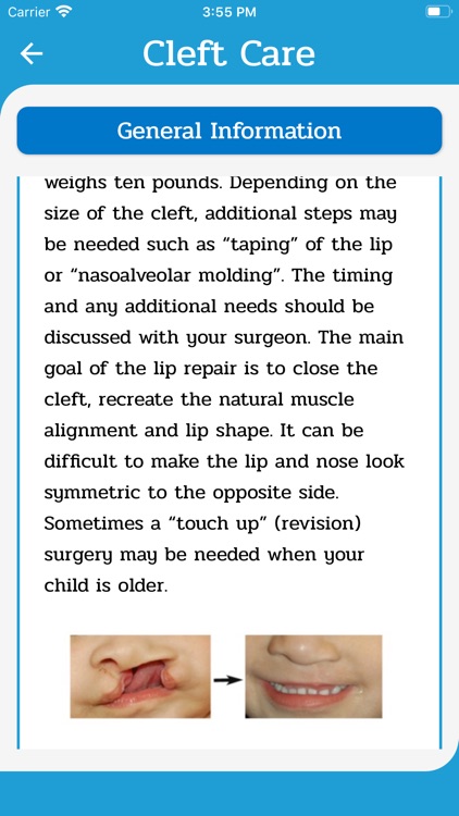 Cleft Care