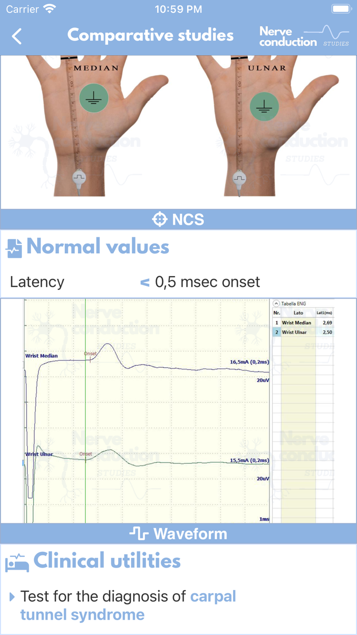 Nerve Conduction Studies
