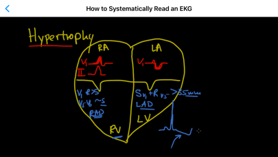 ECG / EKG Explained Clearlyのおすすめ画像4