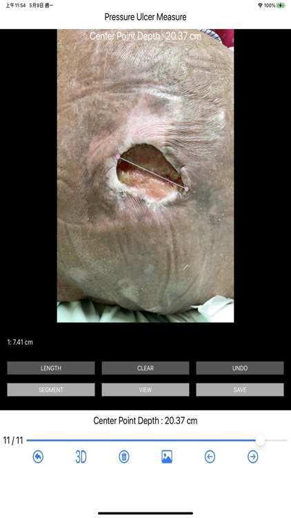 Pressure Ulcer Measure